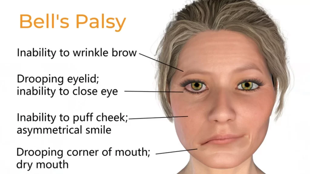 Bell’s Palsy
